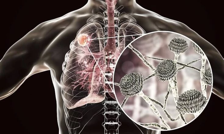 Что за смертоносный грибок Aspergillus, который угрожает погубить миллионы людей